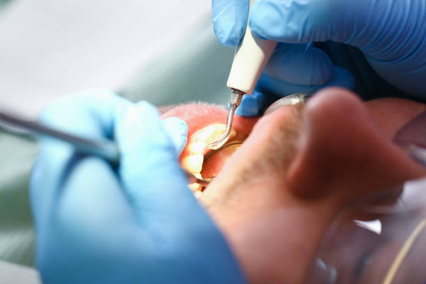 Best Chipped Tooth Repair Near Me  in Newport, MN